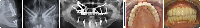 Severely atrophic Maxilla, treated successfully with “angulated implants” Severely atrophic Maxilla, treated successfully with “angulated implants”