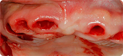 Extract Tooth