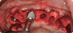 Replace Implant