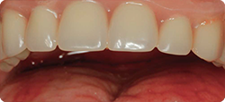 Restore Implant