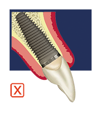 NON-Optimal implant