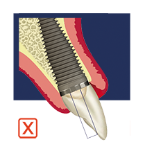 Sub-Optimal implant placement