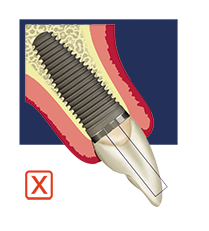 Palatal implant placement