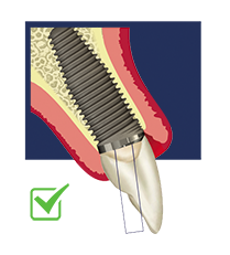 ub crestal angle correction