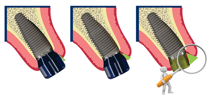 Soft Tissue Thickness Soft Tissue Thickness