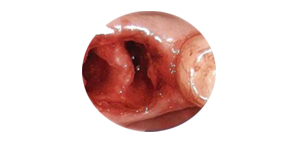 Extract Tooth