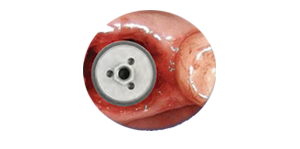 Replace Implant
