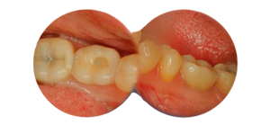 Restore Implant