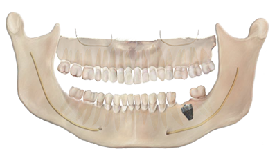 Simplicity in predictable molar rehabilitation Simplicity in predictable molar rehabilitation