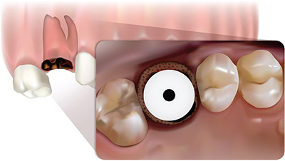 Simplicity in predictable molar rehabilitation Simplicity in predictable molar rehabilitation