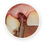 Extract Tooth