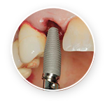 Replace Implant