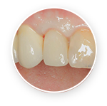 Restore Implant