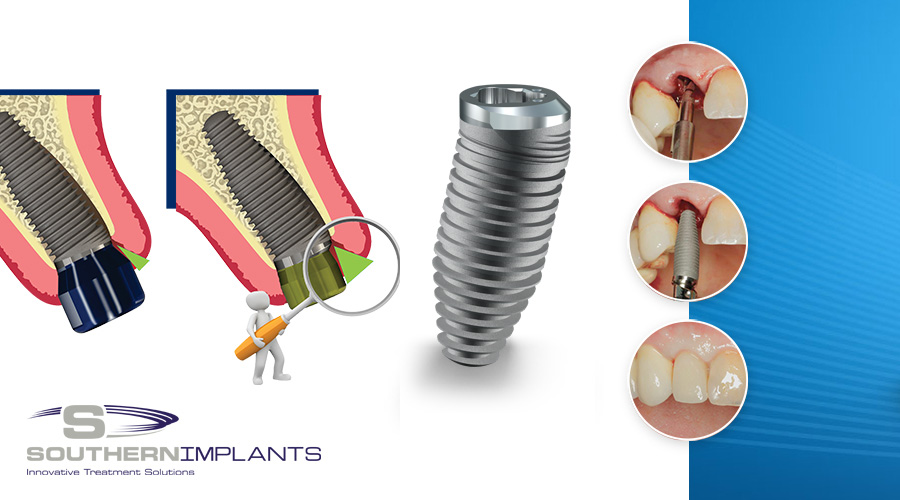 Southern Implants – Predictable Anterior Aesthetics