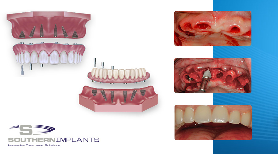 Immediate Full Arch Rehabilitation with Southern Implants