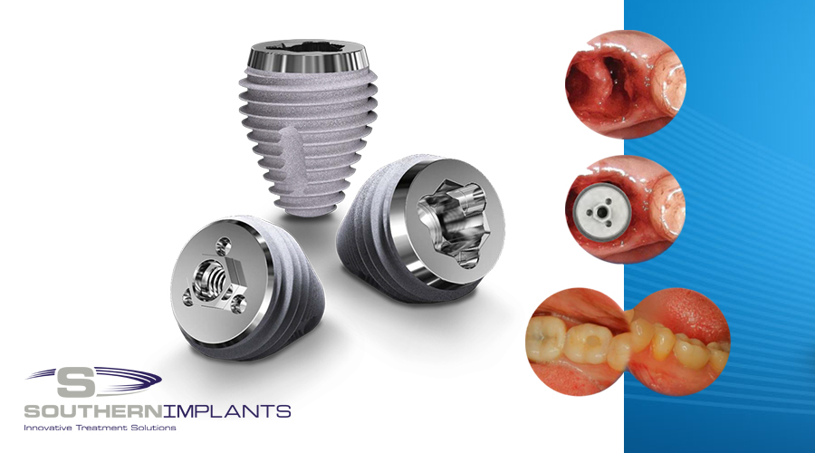 Post Extraction Molar Tooth Replacement with Southern Implants