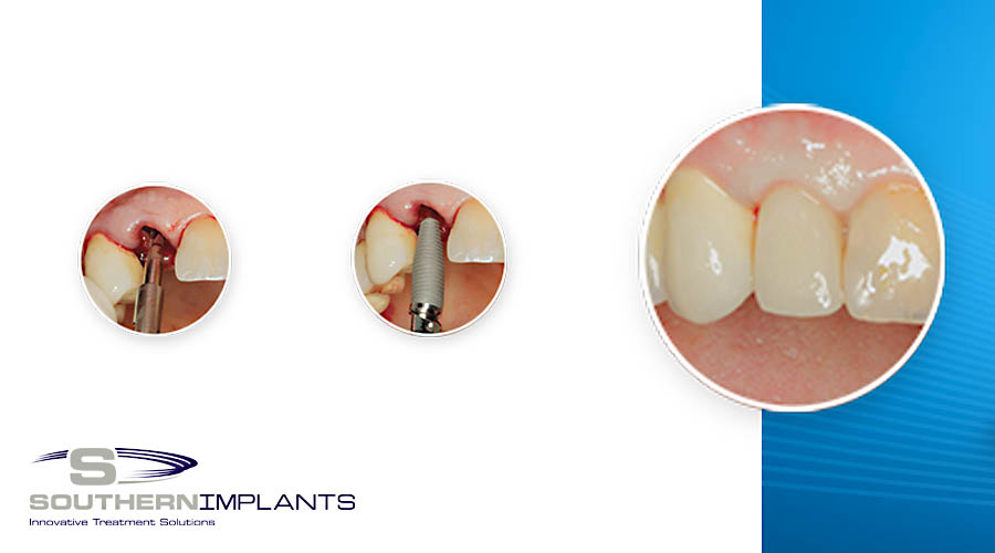 Predictable Anterior Aesthetics with Southern Implants