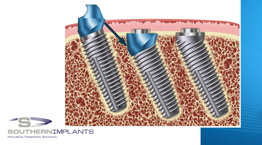 Angled Implant Design to Accommodate Screw-retained Implant-supported Prostheses