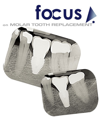 MAX Implant MAX Implant