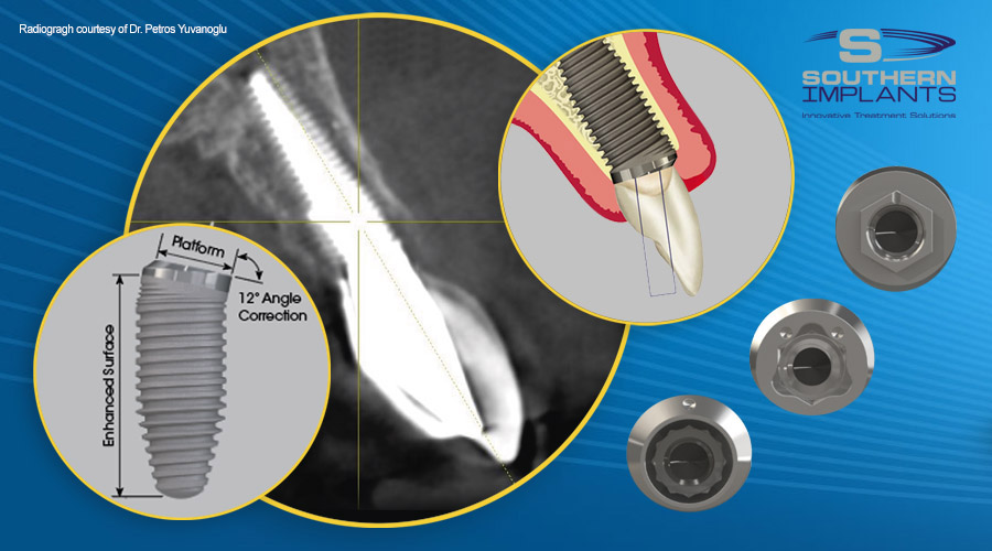 Co-Axis Implants for Subcrestal Angle Correction